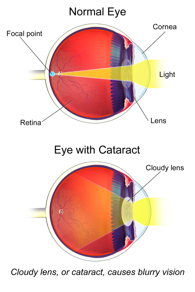 The image compares a normal eye to an eye with a cataract. The top section, labeled "Normal Eye," shows a clear lens focusing light onto the retina, resulting in clear vision. The bottom section, labeled "Eye with Cataract," depicts a cloudy lens scattering light, causing blurry vision. The caption reads, "Cloudy lens, or cataract, causes blurry vision."